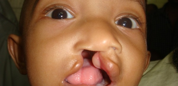 cleftlip