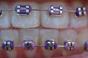 iStock_000002259334XSmall braces on teeth