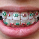 iStock_000002551343XSmall colourful braces on teeth