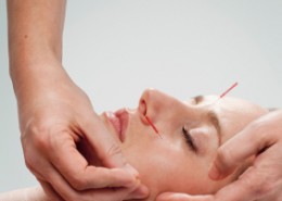 Acupuncture