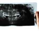iStock_000013123590XSmall root canal x-ray