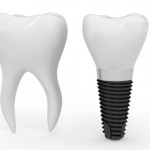 iStock_000014314701XSmall dental implant