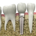 Cross section of a dental implant