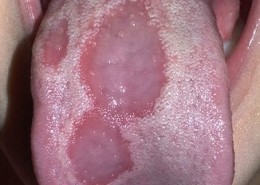 oral_lichen