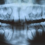 shutterstock_14053951-mixed dentition