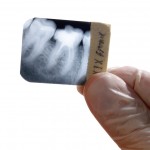 shutterstock_2296216-root canal xray