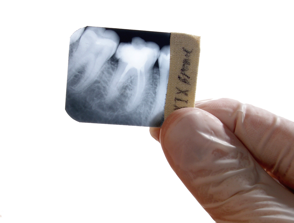 How common is root canal treatment?