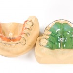 shutterstock_41854831 - removable orthodontic appliance