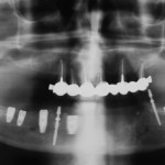 shutterstock_43147957-dental implants