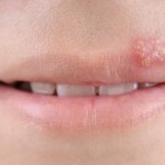 shutterstock_53580727 - cold sore