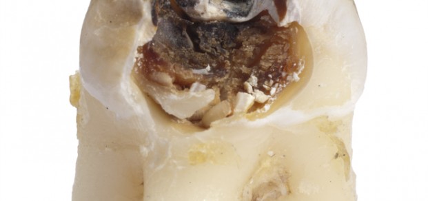 shutterstock_58869371 caries