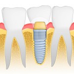 shutterstock_70163050 dental implants