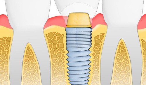 shutterstock_70163050 dental implants