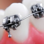 shutterstock_72458023 Dental braces super macro