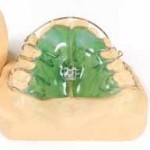 Upper orthodontic appliance