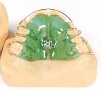 Upper orthodontic appliance
