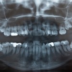 shutterstock_37849495 -impacted wisdom teeth