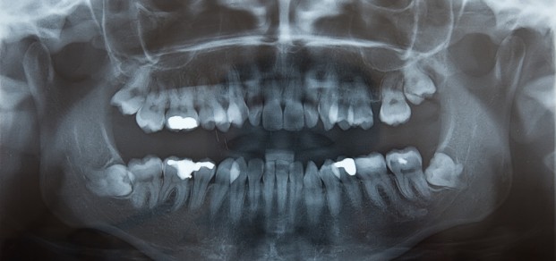 shutterstock_37849495 -impacted wisdom teeth