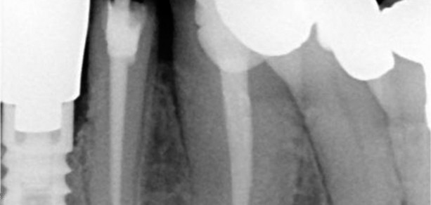 shutterstock_70416955-root canal treatment