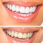 shutterstock_73004329-tooth whitening