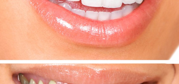 shutterstock_73004329-tooth whitening