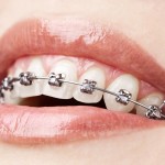 shutterstock_81157801-orthodontic appliance