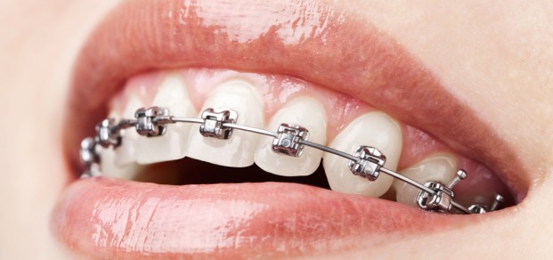 shutterstock_81157801-orthodontic appliance