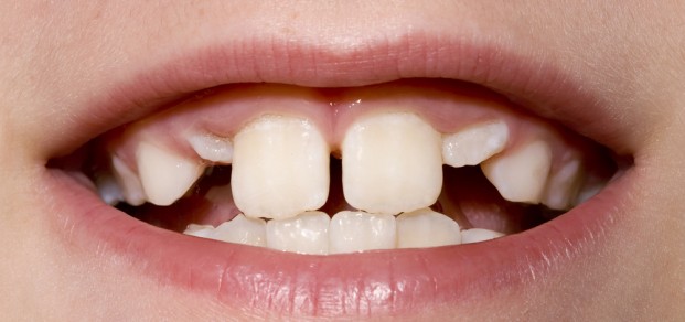 shutterstock_8524240-unerupted canines