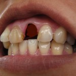 shutterstock_70287046 - avulsed tooth
