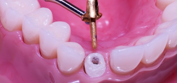 shutterstock_25133602 - Cast post & core on model