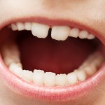 shutterstock_54584944  - mixed dentition