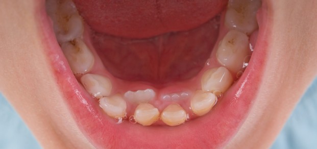 shutterstock_72680830 - erupting incisors & caries