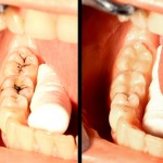 shutterstock_123309100 - tooth coloured restoration before & after