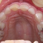 caries upper arch