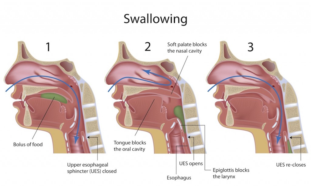 Dysphagia is the difficulty some people have in preparing food in the mouth for swallowing