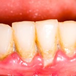 plaque,calculus,periodontal disease