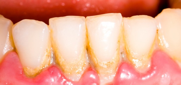 plaque,calculus,periodontal disease