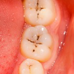 occlusal caries, molar teeth