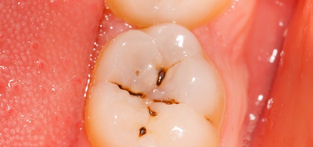 occlusal caries, molar teeth