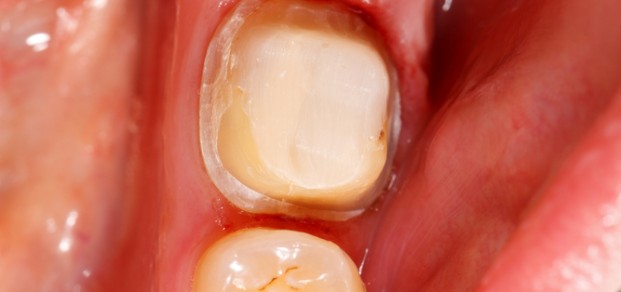 crown preparation