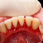 gum disease, scale and polish