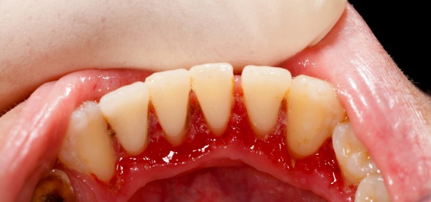 gum disease, scale and polish