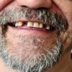 Authors reviewed studies that assessed oral health of people with severe mental illness.