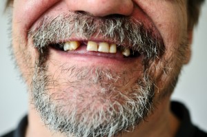 Authors reviewed studies that assessed oral health of people with severe mental illness.