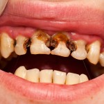 gross caries, anterior teeth