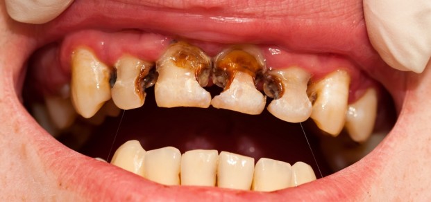 gross caries, anterior teeth