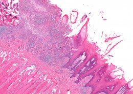 herpetic ulcer on tongue