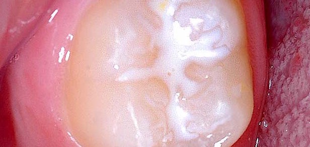 Fissure sealant