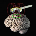 Transcranial_magnetic_stimulation