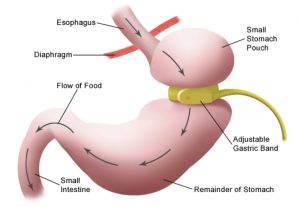 Bariatric surgery is an accepted method of promoting weight loss in severely overweight people.